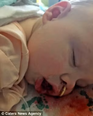 Hai tháng sau, bé Rory được phẫu thuật cắt đi một phần chiếc lưỡi quá khổ. Các bác sĩ đã cắt đầu lưỡi của bé thành hình chữ W rồi khâu lại. Lưỡi của bé vẫn sưng nhưng đã nằm gọn trong miệng. Rory hiện đã 14 tuổi đã hồi phục sau ca phẫu thuật và đã biết gọi mẹ. 