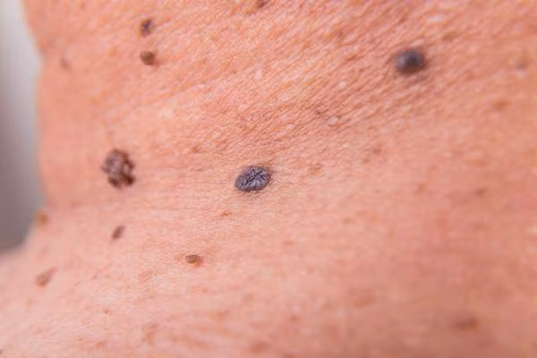 Not ruoi co bat thuong nay, di kham ung thu ngay-Hinh-3