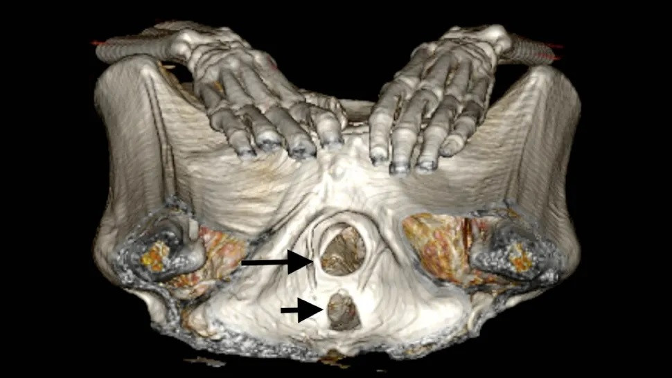 Đây là những vật liệu ướp xác xa xỉ có khả năng được nhập khẩu vào Ai Cập từ Đông Địa Trung Hải và Đông Phi hoặc Nam Ả Rập. Nhựa cây và nhũ hương giúp ngăn thi thể bị phân hủy vi khuẩn và côn trùng.