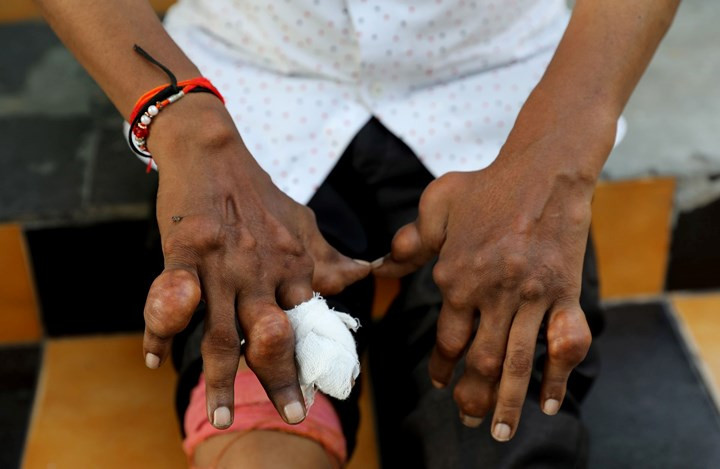 Brij Mohan, 52 tuổi cho rằng những vết sưng phồng trên cơ thể ông là hậu quả của việc hít phải các khí độc khi ông làm công việc dọn ống thải.