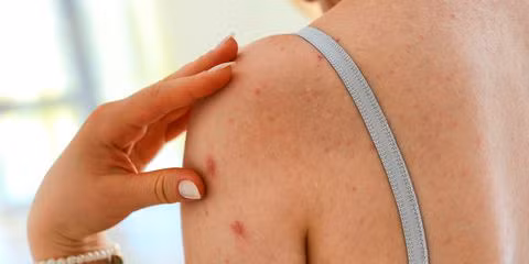 Một số nguyên nhân phổ biến khác của mụn trứng cá là do di truyền, do dùng thuốc, thay đổi hormone, do căng thẳng, và do mồ hôi, đặc biệt là khi mồ hôi bị kẹt dưới quần áo bó sát, kín bí. Thói quen ăn uống nhiều chất béo, hoặc làm tăng lượng đường trong máu cũng góp phần gây ra mụn.