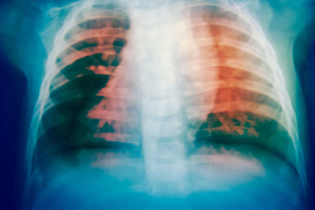  Bệnh lao Khoảng một nửa số người mắc bệnh này có mồ hôi ban đêm. Vi khuẩn thường phát triển trong phổi, khiến người bệnh bị ho nặng và đau đớn. Người bệnh cũng có thể sốt, mệt mỏi, yếu ớt và không cảm thấy thèm ăn.