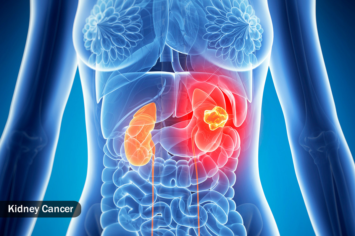  Một số bệnh ung thư Nhiều bệnh ung thư có thể gây ra mồ hôi ban đêm, nhưng phổ biến nhất là ung thư hạch, bắt đầu ở các bộ phận của hệ thống miễn dịch của cơ thể, như các hạch bạch huyết, lá lách, tủy xương và tuyến ức. Ung thư tuyến tiền liệt, ung thư thận, và một số khối u trong buồng trứng và tinh hoàn (cả ung thư và không) là những ví dụ phổ biến về "khối u rắn" cũng gây đổ mồ hôi đêm.