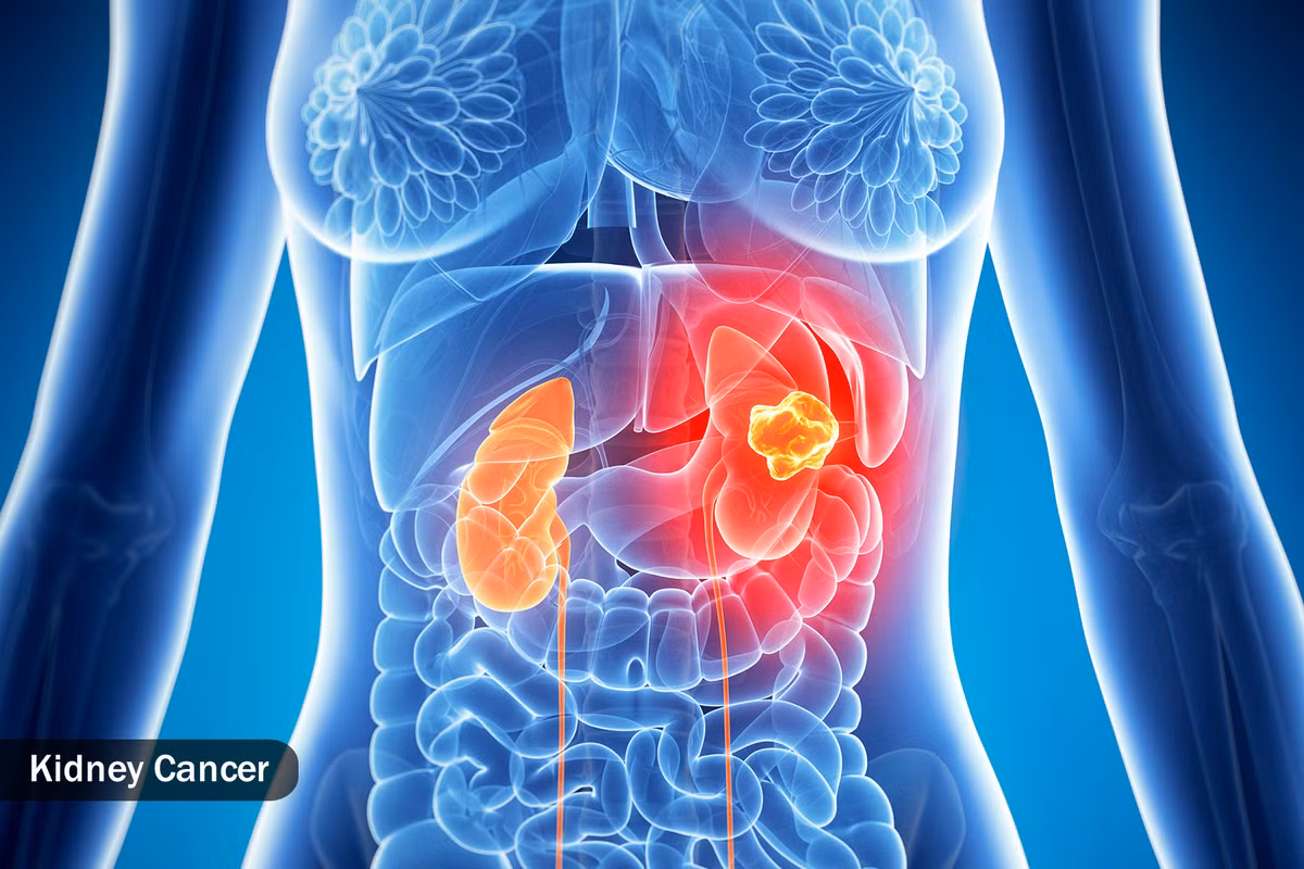  Một số bệnh ung thư Nhiều bệnh ung thư có thể gây ra mồ hôi ban đêm, nhưng phổ biến nhất là ung thư hạch, bắt đầu ở các bộ phận của hệ thống miễn dịch của cơ thể, như các hạch bạch huyết, lá lách, tủy xương và tuyến ức. Ung thư tuyến tiền liệt, ung thư thận, và một số khối u trong buồng trứng và tinh hoàn (cả ung thư và không) là những ví dụ phổ biến về "khối u rắn" cũng gây đổ mồ hôi đêm.