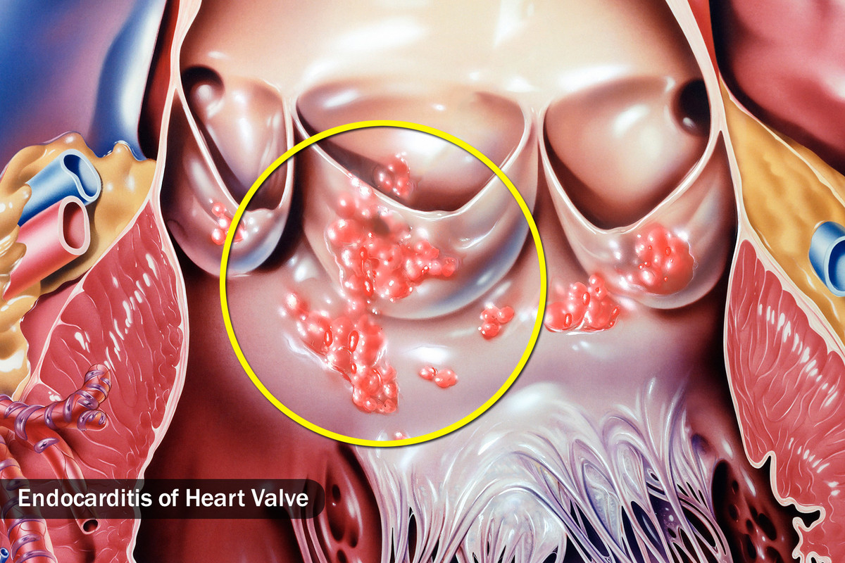  Nhiễm trùng Nhiễm trùng do vi khuẩn có thể gây ra hiện tượng đổ mồ hôi ban đêm, thường là do bị sốt. Các bệnh nhiễm khuẩn phổ biến khác là viêm nội tâm mạc (màng trong của tim), viêm tủy xương (xương) hay áp-xe gan gây nhiễm trùng.