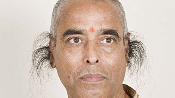 5. Tật di truyền có túm lông ở tai và dính ngón tay 2, 3: Đây là một dạng tật di truyền ở người, do đột biến gen trên nhiễm sắc thể Y gây ra tật này, nên hai tật chỉ có thể gặp ở nam giới. Người bố có tật này thì chắc chắn sinh ra con trai cũng sẽ bị tật giống như bố.