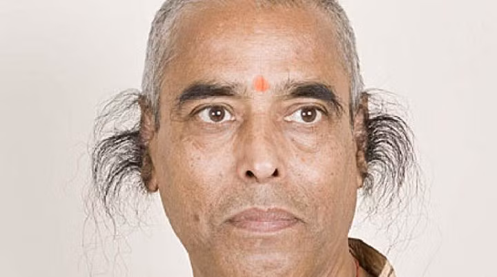 5. Tật di truyền có túm lông ở tai và dính ngón tay 2, 3: Đây là một dạng tật di truyền ở người, do đột biến gen trên nhiễm sắc thể Y gây ra tật này, nên hai tật chỉ có thể gặp ở nam giới. Người bố có tật này thì chắc chắn sinh ra con trai cũng sẽ bị tật giống như bố.