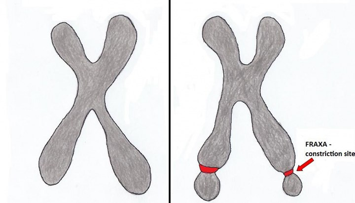 9. Hội chứng nhiễm sắc thể X dễ gãy: Hội chứng nhiễm sắc thể X dễ gây ra các khuyết tật tâm thần di truyền và ảnh hưởng đến những người có testosterone cao và suy giảm buồng trứng sơ cấp. Hội chứng này gây ra một loạt các vấn đề phát triển, bao gồm suy giảm nhận thức và khuyết tật trí tuệ ở trẻ em.
