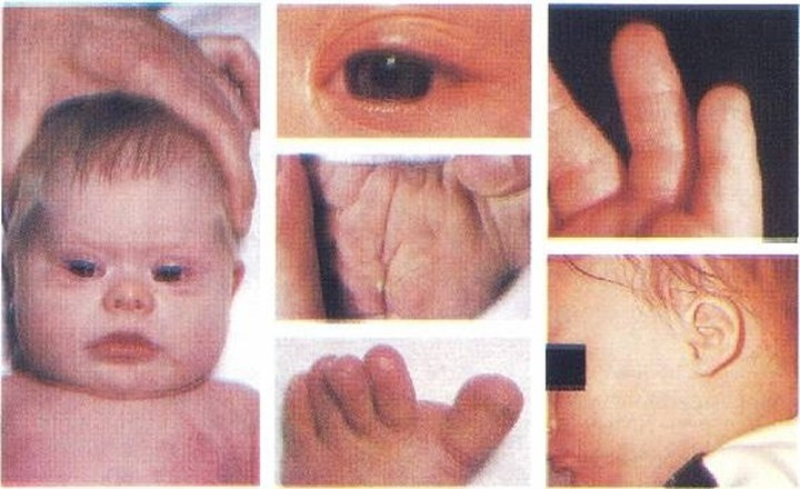 3. Hội chứng Down (tên tiếng Anh là Down Syndrome) là một rối loạn về di truyền xảy ra khi sự phân chia tế bào bất thường dẫn đến việc có thêm một hoặc một phần bản sao của nhiễm sắc thể số 21. Vật chất di truyền tăng thêm này gây ra những thay đổi trong sự phát triển và biểu hiện về thể chất của hội chứng Down.