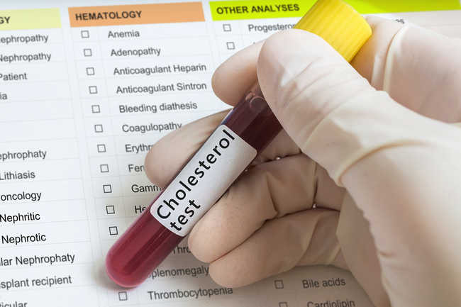  5. Chỉ số lipid Bộ xét nghiệm này đo lường các loại chất béo khác nhau trong máu của bạn: cholesterol "xấu" (LDL), cholesterol "tốt" (HDL) và chất béo trung tính. Nguyên tắc chung là tổng số điểm cholesterol phải nhỏ hơn 200 mg/dL. Tốt nhất là HDL khoảng 60 mg/dL và chất béo trung tính dưới 150 mg/dL. Mức độ không lành mạnh có thể dẫn đến động mạch bị hẹp hoặc bị tắc nghẽn, đau tim và đột quỵ.