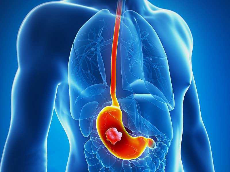 5 benh ung thu nguoi Viet Nam mac phai nhieu nhat hien nay-Hinh-4