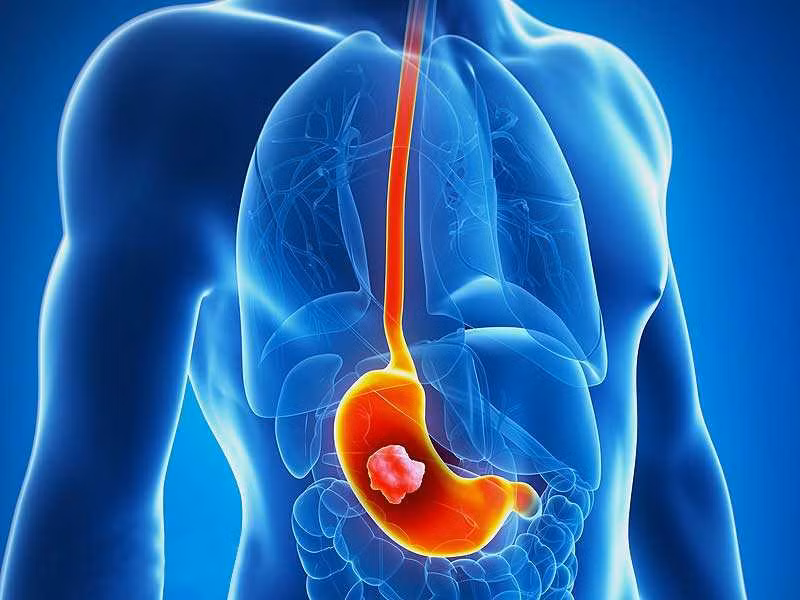 5 benh ung thu nguoi Viet Nam mac phai nhieu nhat hien nay-Hinh-4