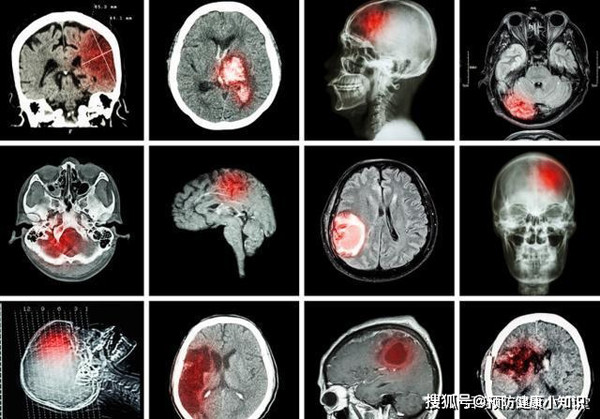 Sau khi kiểm tra, bác sĩ chẩn đoán cả Vương và vợ đều mắc nhồi máu não. Trong khi vợ tai qua nạn khỏi thì may mắn lại không mỉm cười với Vương. Lần nhồi máu não diện rộng khiến anh bị liệt nửa người, việc di chuyển sau này rất khó khăn. Nghe bác sĩ thông báo, người con trai đi cùng bỗng choáng váng, nằm gục tại chỗ. Sau đó, bác sĩ cũng nhận định cậu bị nhồi máu não tương tự như bố mẹ.