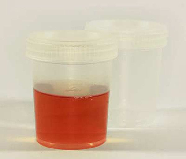 Máu lẫn trong nước tiểu. Máu lẫn trong nước tiểu. Thông thường, thận sẽ giữ lại tế bào hồng cầu trong cơ thể khi lọc độc tố và chất thải từ máu ra để tạo thành nước tiểu. Tuy nhiên, khi các vấn đề sức khỏe về thận phát sinh, hồng cầu có nguy cơ lẫn vào trong nước tiểu và thải ra ngoài cơ thể.