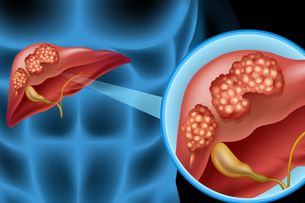 Thông qua trường hợp bệnh của Liêu, bác sĩ cho biết ung thư gan được phát hiện ở bất kì đối tượng nào. Việc phát hiện sớm có ý nghĩa quan trọng trong nỗ lực nâng cao hiệu quả điều trị. Với ung thư gan, bạn không nên bỏ qua dấu hiệu 3 bộ phận cơ thể bốc mùi dưới đây.