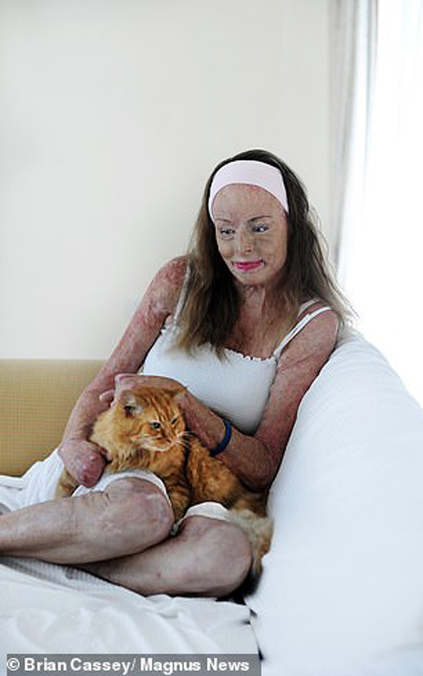 Chia sẻ về tác phẩm nghệ thuật của mình, Carol cho biết: “Bộ ảnh này dành cho những vết bỏng và nỗi đau tâm lý mà bất cứ ai phải trải qua, tôi mong các bạn sẽ có tinh thần chiến đấu như tôi, can đảm vượt qua nó”.