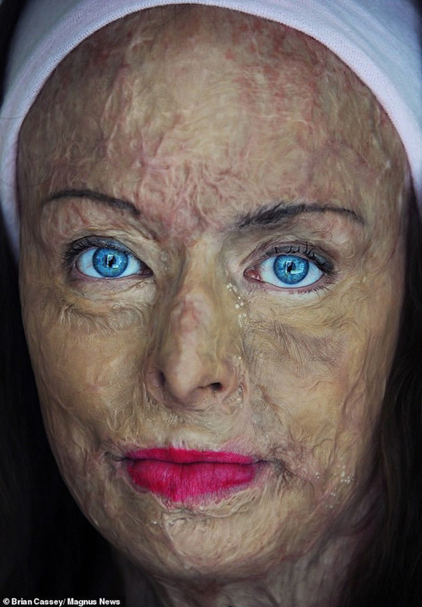 Không chỉ đau đớn 1 lần, sau vụ tai nạn đau lòng, Carol tổng cộng lên bàn mổ phẫu thuật hơn 100 lần. Đau đớn tận cùng song không thể đánh gục ý chí của người phụ nữ.