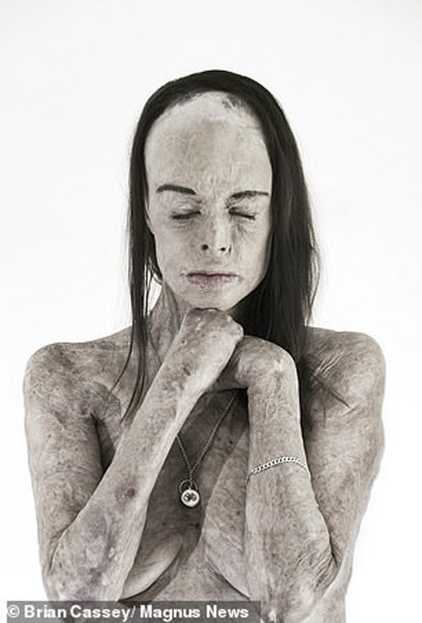 Bộ ảnh nhanh chóng được chọn vào top đề cử cho giải thưởng Portrait of Humanity 2020 do tạp chí nhiếp ảnh The British Journal of Photography tổ chức. Những bức ảnh chân dung được đặt tên là “The Skin I’m In”.