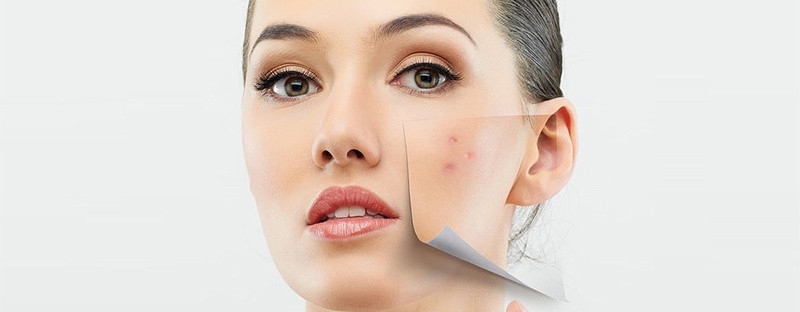 Su dung cong thuc nay tieu diet mun an tan goc-Hinh-2