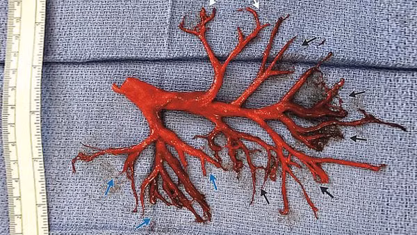 Hy hữu người đàn ông ho ra cả 'cây phế quản' rồi qua đời Hy huu nguoi dan ong ho ra ca 'cay phe quan' roi qua doi