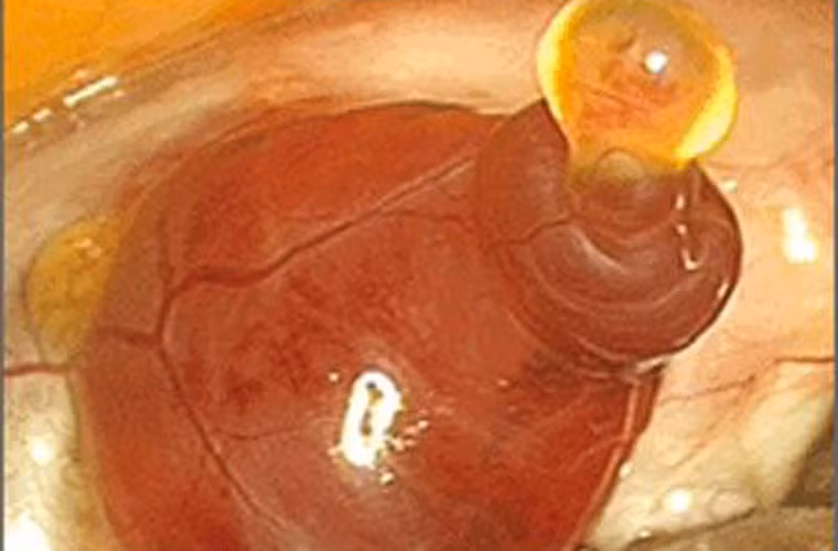 Các nhà khoa học phát hiện, khi một quả trứng được phóng ra khỏi buồng, rơi vào ống dẫn trứng sẽ kéo theo lớp chất lỏng thoát khỏi buồng trứng cùng yếu tố có khả năng gây thiệt hại DNA của tế bào ống dẫn trứng gần đó.