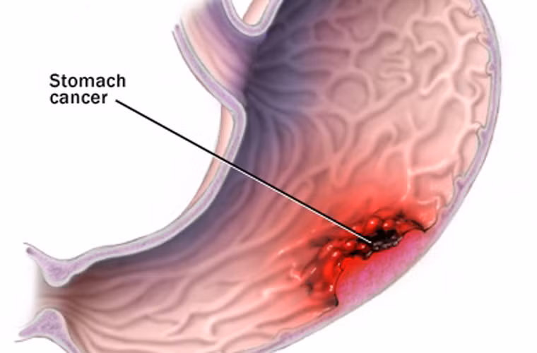 Đây cũng là một trong những loại ung thư phổ biến nhất tấn công nam giới nước này. Khoảng 4.600 ca quý ông được phát hiện mắc bệnh năm 2011.