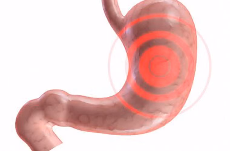 Đáng lưu ý, tỷ lệ sống sót khi mắc ung thư dạ dày khá thấp. Chỉ khoảng 1/5 trường hợp được phát hiện bệnh có khả năng sống sót sau 5 năm.