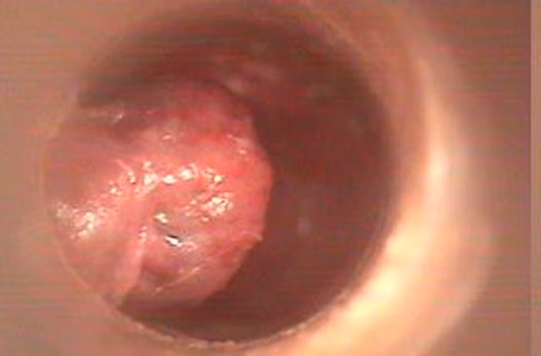 Đặc biệt, đối tượng có quan hệ với người đồng giới thường có nguy cơ nhiễm HPV, đối diện với ung thư hậu môn cao hơn nhiều.