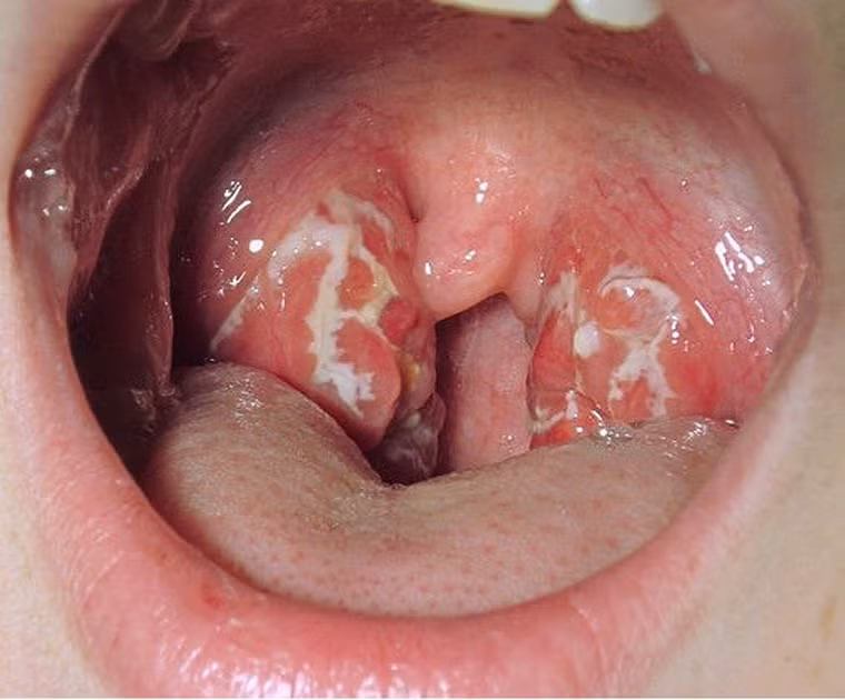 Các chủng HPV thường được truyền qua đường tình dục. Nhóm có khả năng gây mụn cóc khi tấn công có thể được nhận dạng thông qua những mụn bất thường tại cơ quan sinh dục. Ngược lại, những chủng thuộc nhóm HR thường ít có triệu chứng đặc trưng, khó có thể nhận diện ở giai đoạn sớm.