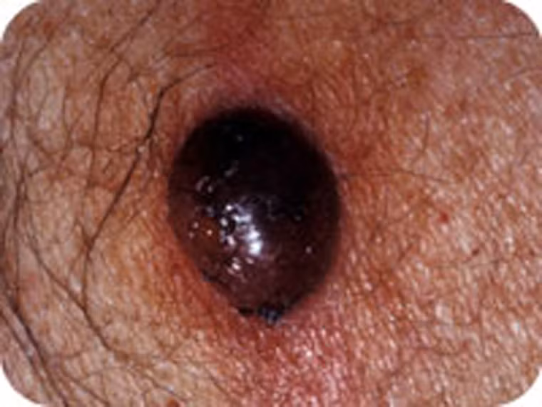  U da nodular melanoma. Dù không nguy hiểm như u da melanoma song u da nodular melanoma có tốc độ di căn cực nhanh. Từ một khối u nhỏ, nó nhanh chóng tăng trưởng về kích thước, màu sắc. 