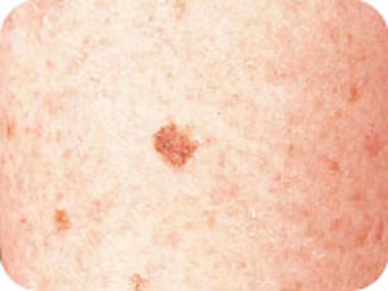  Ung thư da melanoma. Đây được xem là dạng ung thư da ác tính nguy hiểm nhất. Nếu không được điều trị kịp thời, tế bào ung thư dễ dàng di căn tới bộ phận khác trong cơ thể. 