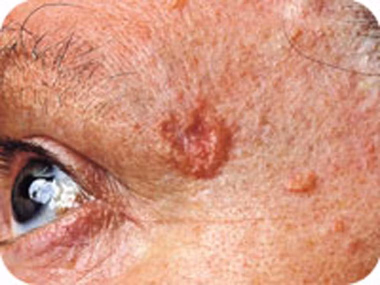  Ung thư biểu mô tế bào đáy. Đây được xem là dạng ung thư phổ biến nhất. Khối u, vết loét của ung thư biểu mô tế bào đáy thường có màu đỏ, hồng nhạt, trắng ngọc trai. 