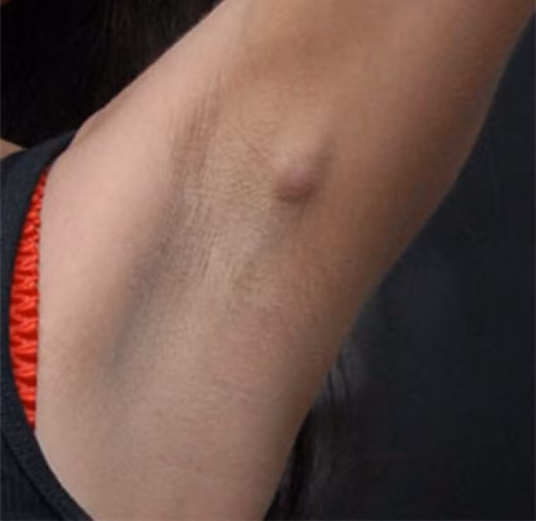 Xuất hiện khối u, mô xơ cứng. Tế bào ung thư tích tụ, phát triển mạnh có xu hướng tạo nên những khối u, mô xơ cứng dưới da. Nhìn chung, tình trạng này chủ yếu xảy ra ở vú, tinh hoàn và hạch bạch huyết.