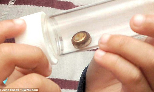 Viên pin điện tử nằm trong mũi cậu bé suốt 1 tháng mới được phát hiện, loại bỏ.