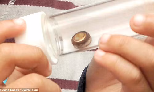 Viên pin điện tử nằm trong mũi cậu bé suốt 1 tháng mới được phát hiện, loại bỏ.