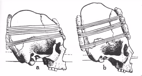 Tuy nhiên, một số trường hợp bị tổn thương não trong quá trình làm biến dạng hộp sọ. Theo đó, những đứa trẻ sẽ đối mặt với thương tật vĩnh viễn, thậm chí là tử vong.