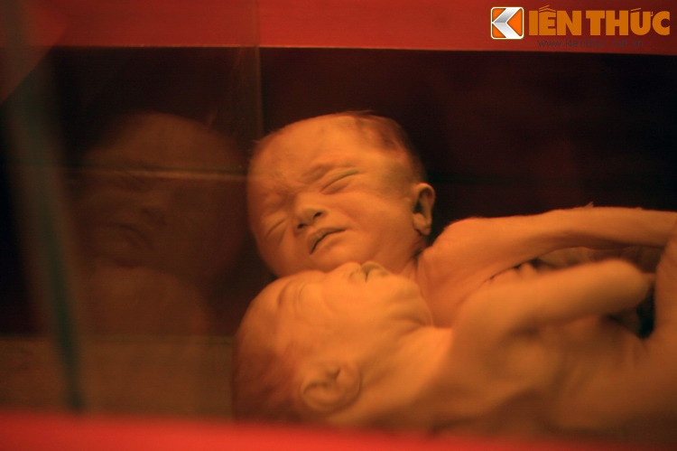 Thi hài hai em bé dính liền - nạn nhân chất độc da cam của Mỹ thời chiến tranh Việt Nam - là hiện vật đã khiến nhiều du khách rơi lệ khi chứng kiến.