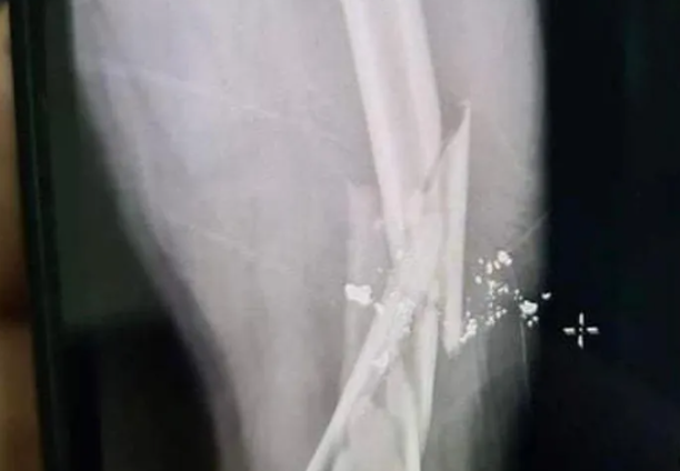  Mâu thuẫn tại bàn nhậu, người đàn ông bị bắn gãy xương đùi: Do mâu thuẫn tại bàn nhậu, Phan Công Hòa (SN 1981, trú tại huyện Kỳ Anh, Hà Tĩnh) đã dùng súng thể thao bắn anh(SN 1977, trú thị xã Kỳ Anh) khiến nạn nhân bị gãy xương đùi. Ngày 14/1, Công an thị xã Kỳ Anh cho biết đang tạm giữ Hòa để điều tra, làm rõ.