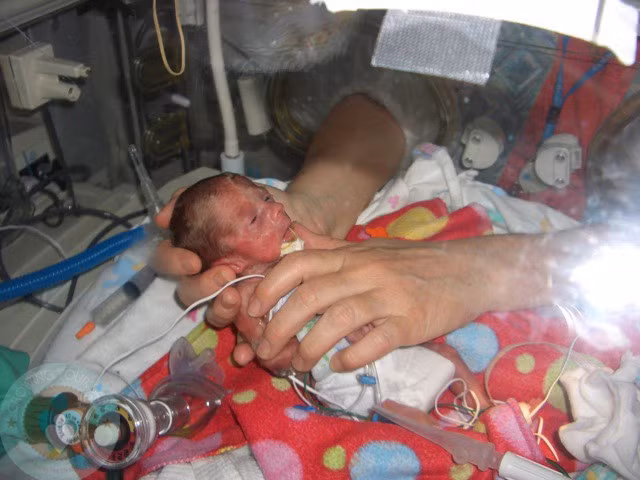 Brielle gặp vấn đề về thở, nhịp tim, lại còn quá nhẹ cân, mức oxy trong cơ thể thấp. (Ảnh: Internet)