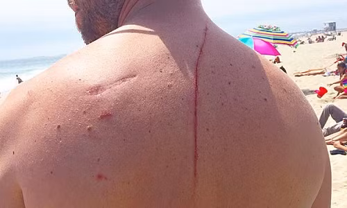 Vết thương do cá mập tấn công.