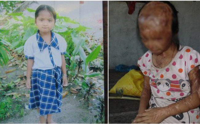  3. Nữ sinh Nguyễn Thị Yến Nhi (SN 2005) đang sinh sống cùng bà nội của mình ở ấp Kinh Mới (xã Hòa Bình, huyện Trà Ôn, tỉnh Vĩnh Long). Nhi là nạn nhân của vụ đánh ghen kinh hoàng xảy ra vào 7 năm trước khi mẹ ruột của em giật chồng người khác.