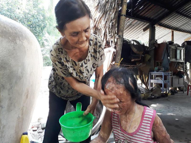 Chính quyền địa phương cho biết hoàn cảnh của gia đình Nhi luôn được quan tâm, tạo điều kiện giúp đỡ cũng như được hỗ trợ, quyên góp từ nhiều mạnh thường quân. Kẻ đã tạt axit vào người Nhi cũng đã nhận mức án 18 năm tù giam. Mẹ của Nhi thì bỏ đi theo tình mới, chưa 1 lần về thăm con.