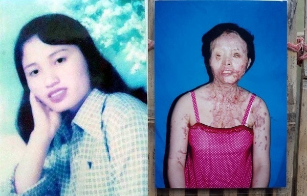  5. Đang ngủ bị tạt axit qua cửa sổ: Ngày 21/4/2006 khi chị Phạm Thị Lương )SN 1982, quê Hà Tĩnh) nằm ngủ trong phòng, sát cửa sổ vẫn thường mở ra cho thoáng. Chị Lương đã bị tạt axit vào mặt và cổ. Nạn nhân bị thương tật vĩnh viễn tới tỷ lệ 81%.