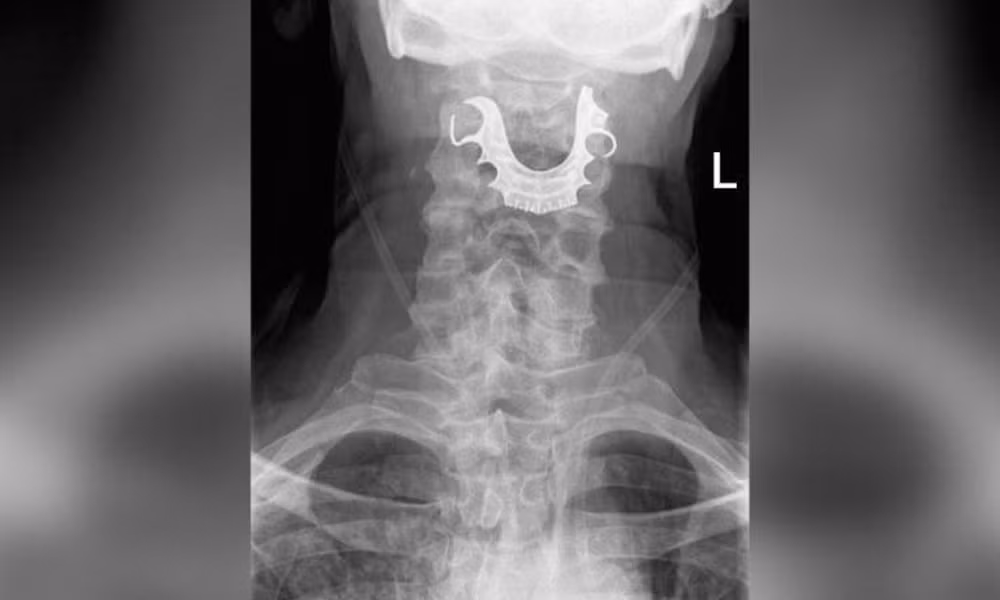 Cu ong 72 tuoi suyt chet vi rang gia roi tot vao hong