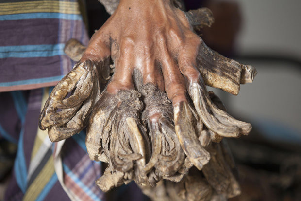 Người mắc hội chứng người cây thường có các nốt, các mảnh chai sần như vỏ cây mọc trên mặt hoặc các đầu chi.