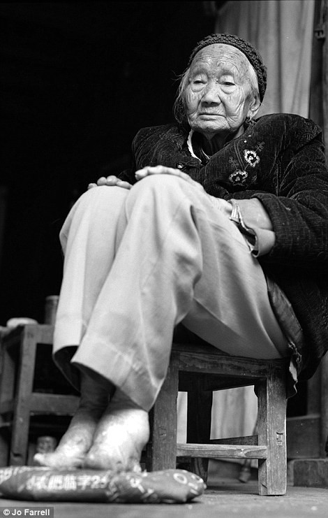 Thậm chí, một số người bị nhiễm trùng khiến ngón chân bị hoại tử, thậm chí có nguy cơ gây tử vong.