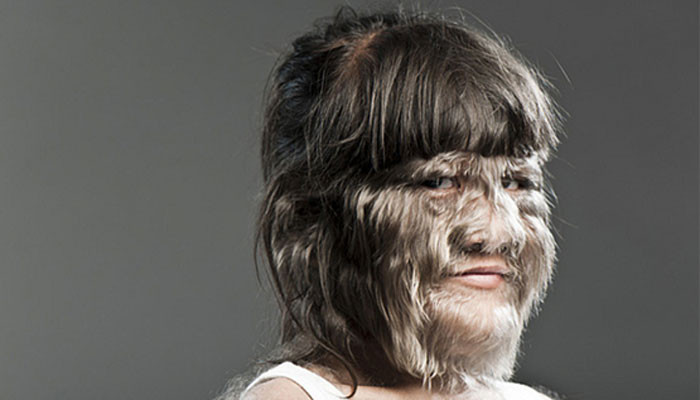 Hội chứng người sói (Werewolf Syndrome) là một chứng bệnh khá hiếm gặp. Trên thế giới mới chỉ ghi nhận khoảng 50 trường hợp mắc phải hội chứng này.