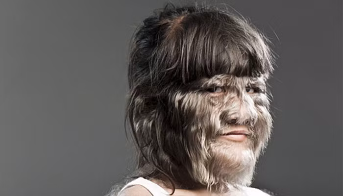 Hội chứng người sói (Werewolf Syndrome) là một chứng bệnh khá hiếm gặp. Trên thế giới mới chỉ ghi nhận khoảng 50 trường hợp mắc phải hội chứng này.