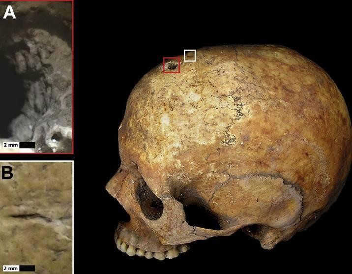 Hiện tượng hiếm gặp và bất thường này chỉ xảy ra khi thai nhi trong bụng người mẹ đã chết bị tống ra ngoài sau khi được chôn cất. Hộp sọ và phần thân trên của thai nhi nằm bên ngoài xương chậu của người phụ nữ.