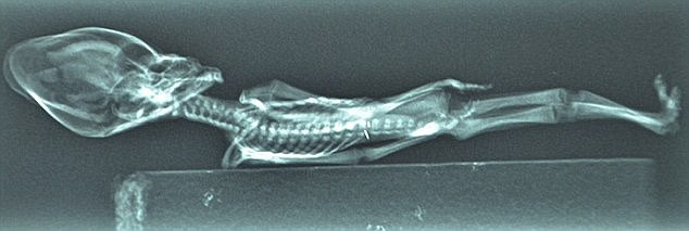 Bé gái sơ sinh này có nhiều đột biến gene gắn liền với chứng lùn, vẹo cột sống và nhiều bất thường ở hệ cơ và xương.